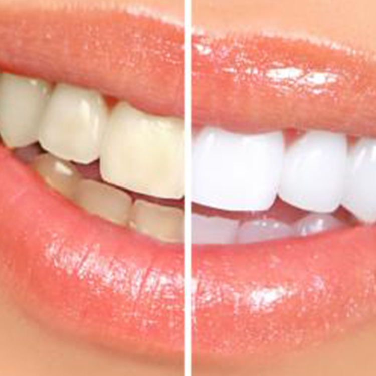 Teeth Whitening Greater York Family Dentistry