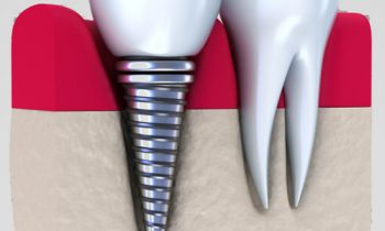 Greater York Family Dentistry- Dental Implants