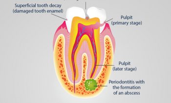 Greater York Family Dentistry- Root Canal Treatment