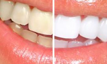 Greater York Family Dentistry- Teeth Whitening